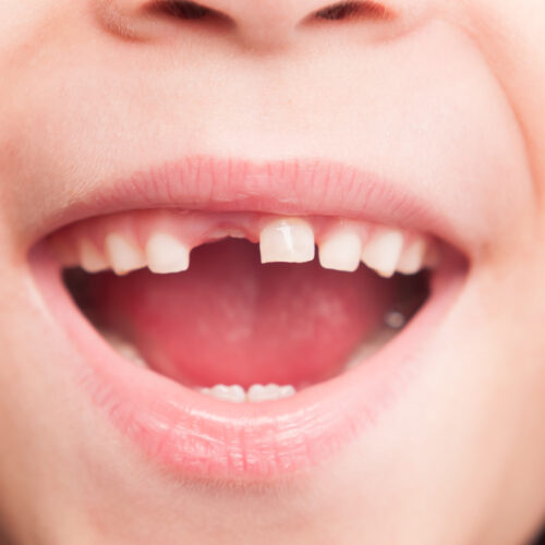 rfk-jr’s-plan-to-ban-fluoride-supplements-will-“hurt-rural-america,”-dentists-say