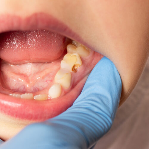 rfk-jr’s-fluoride-ban-would-ruin-25-million-kids’-teeth,-cost-$9.8-billion