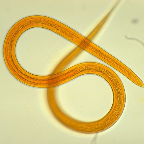 man’s-health-crashes-after-getting-donated-kidney—it-was-riddled-with-worms