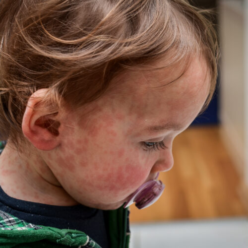 Child dies of horrifying measles complication in Los Angeles