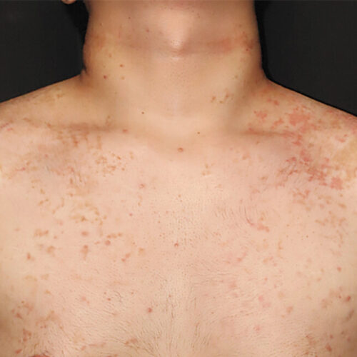 a-weird,-itchy-rash-is-linked-to-the-keto-diet—but-no-one-knows-why