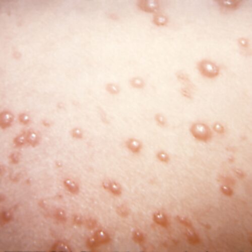 in-rare-chickenpox-case,-itchy-blisters-mushroom-into-large,-rubbery-nodules