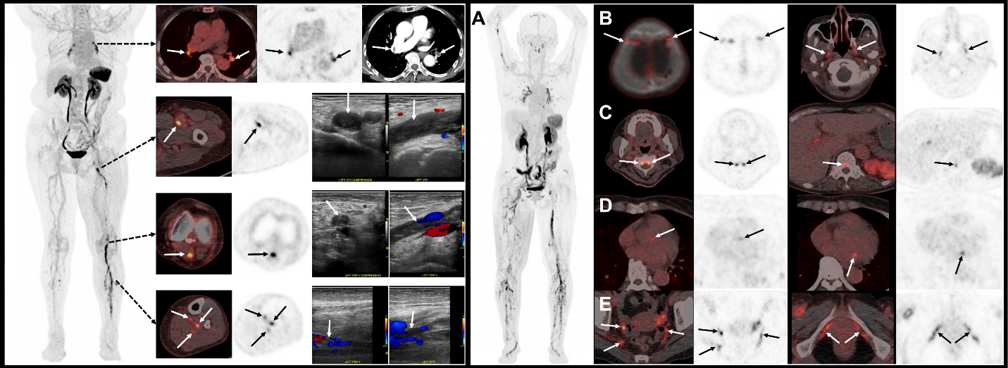 lantheus’-lnth-2513-(18f-gp1)-pet/ct-awarded-snmmi’s-image-of-the-year