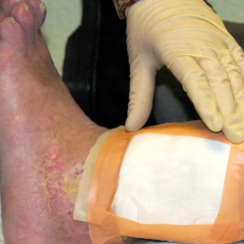 second-carcass-eating-fly-species-cleared-by-fda-for-maggot-wound-therapy