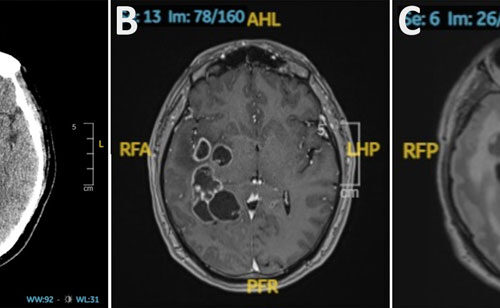 doctors-suspected-man-had-brain-cancer-he-actually-had-worms.