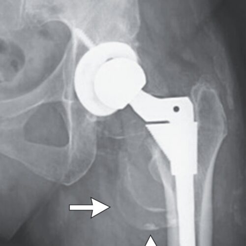 woman’s-hip-replacement-disintegrates,-causing-severe-metal-poisoning