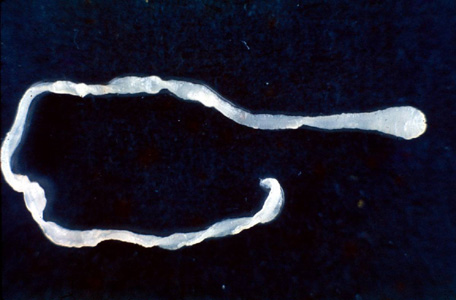 surprised-doctors-find-10-inch-worm-in-man’s-groin-during-elective-surgery