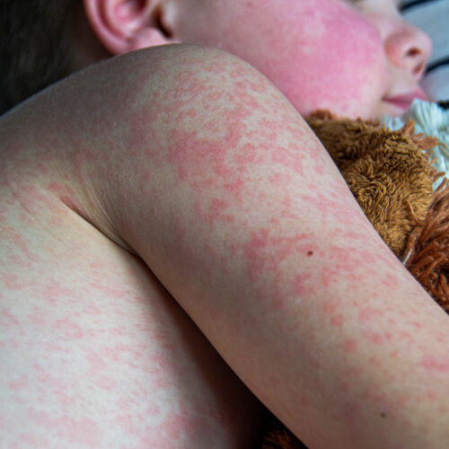 two-unvaccinated-people-die-from-measles-in-pennsylvania,-officials-confirm