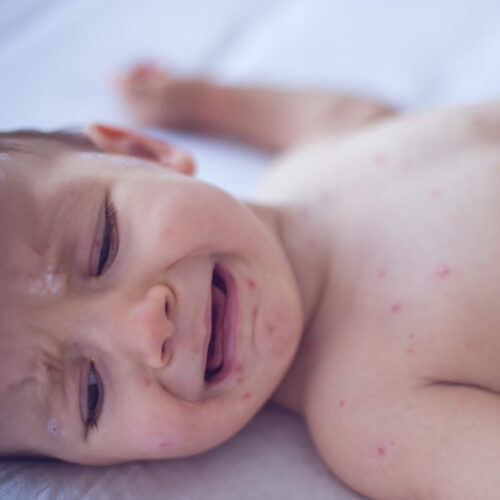 measles-killed-6-week-old-baby,-coroner-confirms-after-rfk-jr.-disputed-deaths