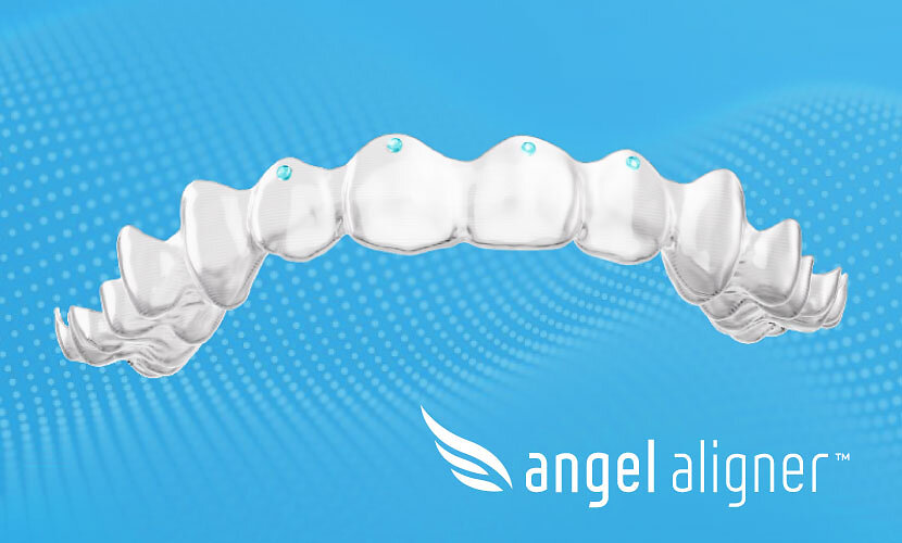 angel-aligner-upgrades-torque-ridges-to-“pressure-points”-in-europe