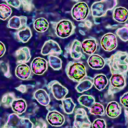 39-year-old-unvaccinated-woman-becomes-6th-measles-death-in-pennsylvania