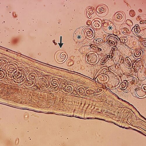 worms-mate-in-man’s-eyes,-get-plucked-out-right-before-larvae-burst-out